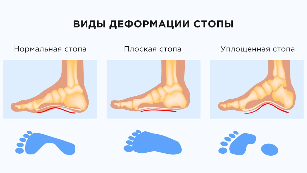 Вальгусная деформация стопы у ребенка: что это такое, лечение и причины искривления ноги